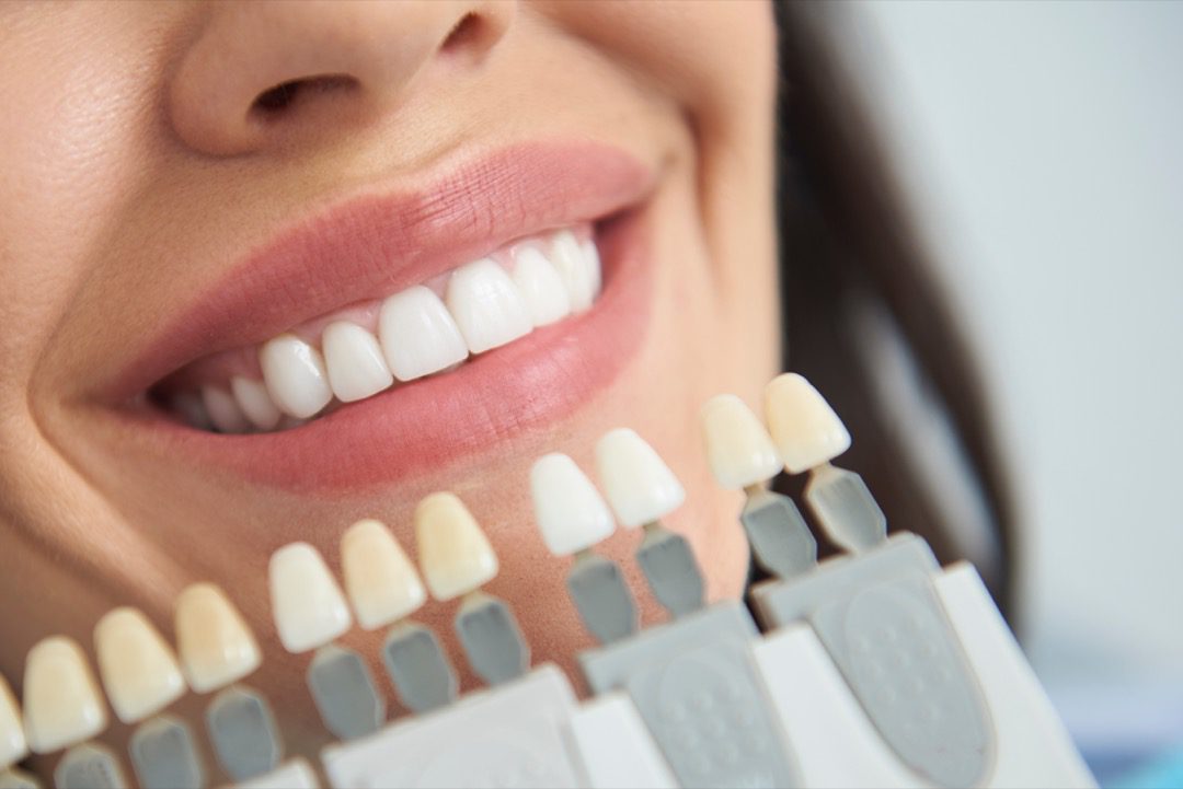 Woman having teeth whitened